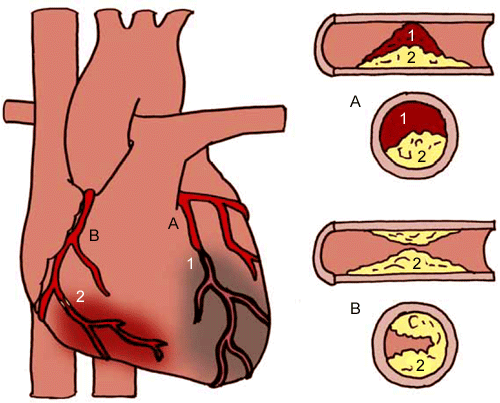 Hartinfarct en angina pectoris